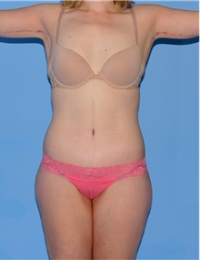 Body Contouring After Photo by Siamak Agha, MD PhD FACS; Newport Beach, CA - Case 43993