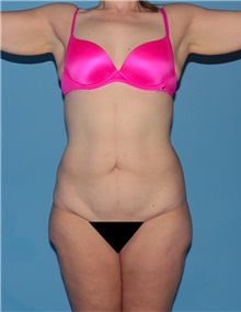 Body Contouring Before Photo by Siamak Agha, MD PhD FACS; Newport Beach, CA - Case 43993