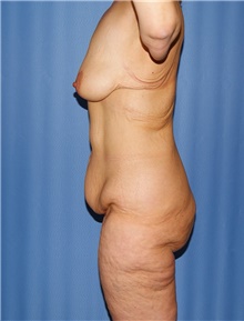 Body Contouring Before Photo by Siamak Agha, MD PhD FACS; Newport Beach, CA - Case 43996