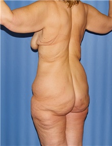 Body Contouring Before Photo by Siamak Agha, MD PhD FACS; Newport Beach, CA - Case 43996