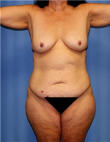 Body Contouring Before Photo by Siamak Agha, MD PhD FACS; Newport Beach, CA - Case 43998