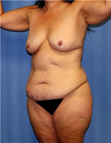 Body Contouring Before Photo by Siamak Agha, MD PhD FACS; Newport Beach, CA - Case 43998