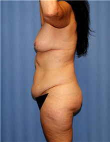 Body Contouring Before Photo by Siamak Agha, MD PhD FACS; Newport Beach, CA - Case 43998