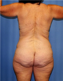 Body Contouring Before Photo by Siamak Agha, MD PhD FACS; Newport Beach, CA - Case 43998