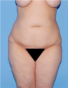 Body Contouring Before Photo by Siamak Agha, MD PhD FACS; Newport Beach, CA - Case 44072