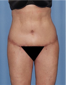 Body Contouring After Photo by Siamak Agha, MD PhD FACS; Newport Beach, CA - Case 44073