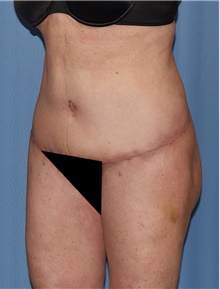 Body Contouring After Photo by Siamak Agha, MD PhD FACS; Newport Beach, CA - Case 44073