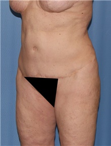 Body Contouring Before Photo by Siamak Agha, MD PhD FACS; Newport Beach, CA - Case 44073