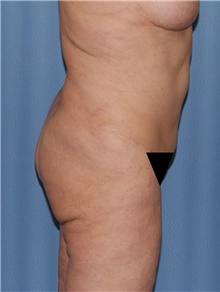 Body Contouring Before Photo by Siamak Agha, MD PhD FACS; Newport Beach, CA - Case 44073