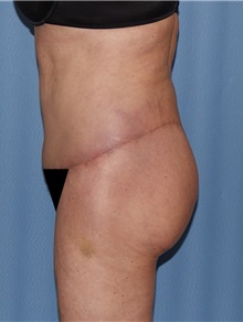 Body Contouring After Photo by Siamak Agha, MD PhD FACS; Newport Beach, CA - Case 44073