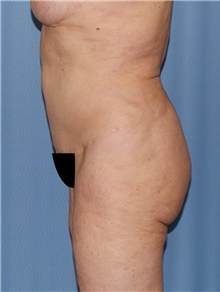 Body Contouring Before Photo by Siamak Agha, MD PhD FACS; Newport Beach, CA - Case 44073