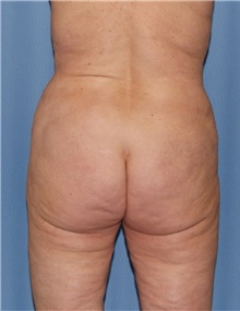 Body Contouring Before Photo by Siamak Agha, MD PhD FACS; Newport Beach, CA - Case 44073