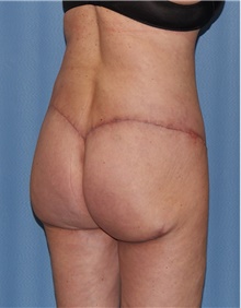 Body Contouring After Photo by Siamak Agha, MD PhD FACS; Newport Beach, CA - Case 44073