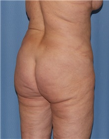 Body Contouring Before Photo by Siamak Agha, MD PhD FACS; Newport Beach, CA - Case 44073