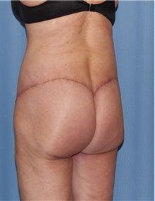 Body Contouring After Photo by Siamak Agha, MD PhD FACS; Newport Beach, CA - Case 44073