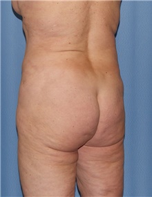 Body Contouring Before Photo by Siamak Agha, MD PhD FACS; Newport Beach, CA - Case 44073