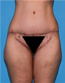 Body Contouring Before Photo by Siamak Agha, MD PhD FACS; Newport Beach, CA - Case 44078