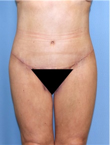 Body Contouring After Photo by Siamak Agha, MD PhD FACS; Newport Beach, CA - Case 44107