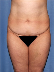 Body Contouring Before Photo by Siamak Agha, MD PhD FACS; Newport Beach, CA - Case 44107