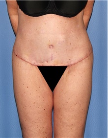 Body Contouring After Photo by Siamak Agha, MD PhD FACS; Newport Beach, CA - Case 44108