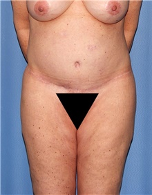 Body Contouring Before Photo by Siamak Agha, MD PhD FACS; Newport Beach, CA - Case 44108