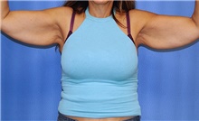 Arm Lift Before Photo by Siamak Agha, MD PhD FACS; Newport Beach, CA - Case 44118