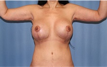 Arm Lift After Photo by Siamak Agha, MD PhD FACS; Newport Beach, CA - Case 44137