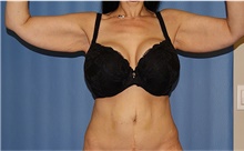 Arm Lift Before Photo by Siamak Agha, MD PhD FACS; Newport Beach, CA - Case 44137