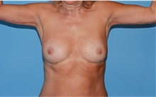 Body Contouring After Photo by Siamak Agha, MD PhD FACS; Newport Beach, CA - Case 44142