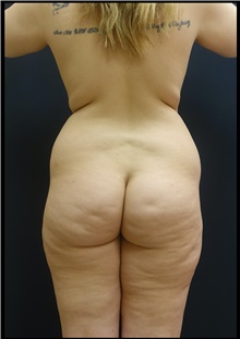 Buttock Lift with Augmentation Before Photo by Johnny Franco, MD; Austin, TX - Case 44287