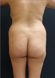 Buttock Lift with Augmentation Before Photo by Johnny Franco, MD; Austin, TX - Case 44290