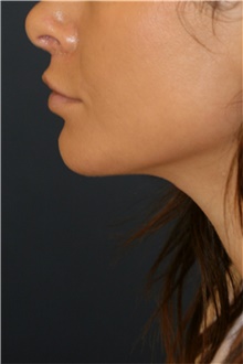 Chin Augmentation After Photo by Steve Laverson, MD, FACS; Rancho Santa Fe, CA - Case 44369