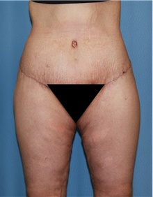 Thigh Lift After Photo by Siamak Agha, MD PhD FACS; Newport Beach, CA - Case 44533