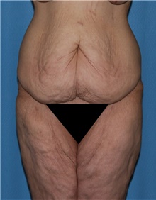 Thigh Lift Before Photo by Siamak Agha, MD PhD FACS; Newport Beach, CA - Case 44533