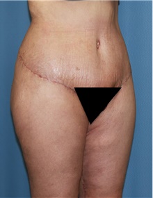 Thigh Lift After Photo by Siamak Agha, MD PhD FACS; Newport Beach, CA - Case 44533