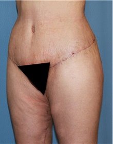 Thigh Lift After Photo by Siamak Agha, MD PhD FACS; Newport Beach, CA - Case 44533