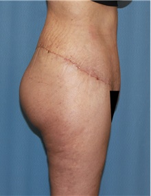 Thigh Lift After Photo by Siamak Agha, MD PhD FACS; Newport Beach, CA - Case 44533