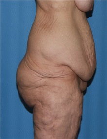 Thigh Lift Before Photo by Siamak Agha, MD PhD FACS; Newport Beach, CA - Case 44533