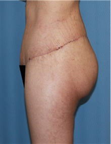 Thigh Lift After Photo by Siamak Agha, MD PhD FACS; Newport Beach, CA - Case 44533