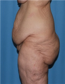 Thigh Lift Before Photo by Siamak Agha, MD PhD FACS; Newport Beach, CA - Case 44533