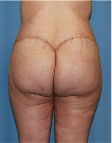 Thigh Lift After Photo by Siamak Agha, MD PhD FACS; Newport Beach, CA - Case 44533