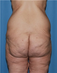 Thigh Lift Before Photo by Siamak Agha, MD PhD FACS; Newport Beach, CA - Case 44533