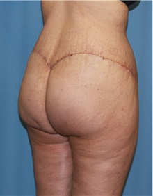 Thigh Lift After Photo by Siamak Agha, MD PhD FACS; Newport Beach, CA - Case 44533