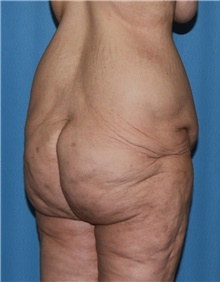 Thigh Lift Before Photo by Siamak Agha, MD PhD FACS; Newport Beach, CA - Case 44533