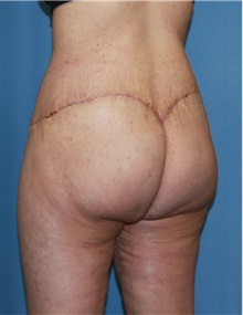 Thigh Lift After Photo by Siamak Agha, MD PhD FACS; Newport Beach, CA - Case 44533