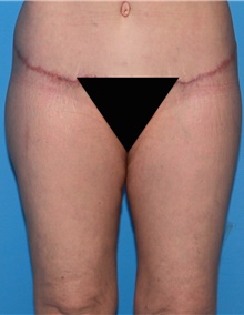 Thigh Lift After Photo by Siamak Agha, MD PhD FACS; Newport Beach, CA - Case 44534