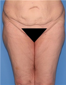 Thigh Lift Before Photo by Siamak Agha, MD PhD FACS; Newport Beach, CA - Case 44534