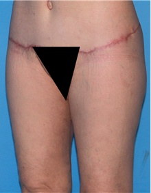 Thigh Lift After Photo by Siamak Agha, MD PhD FACS; Newport Beach, CA - Case 44534