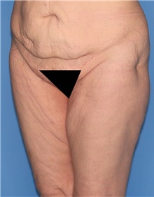 Thigh Lift Before Photo by Siamak Agha, MD PhD FACS; Newport Beach, CA - Case 44534