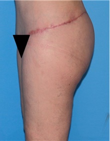 Thigh Lift After Photo by Siamak Agha, MD PhD FACS; Newport Beach, CA - Case 44534